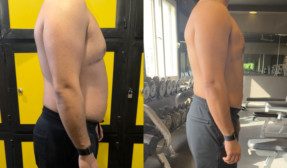 Client before and after, side profile with a much flatter stomach